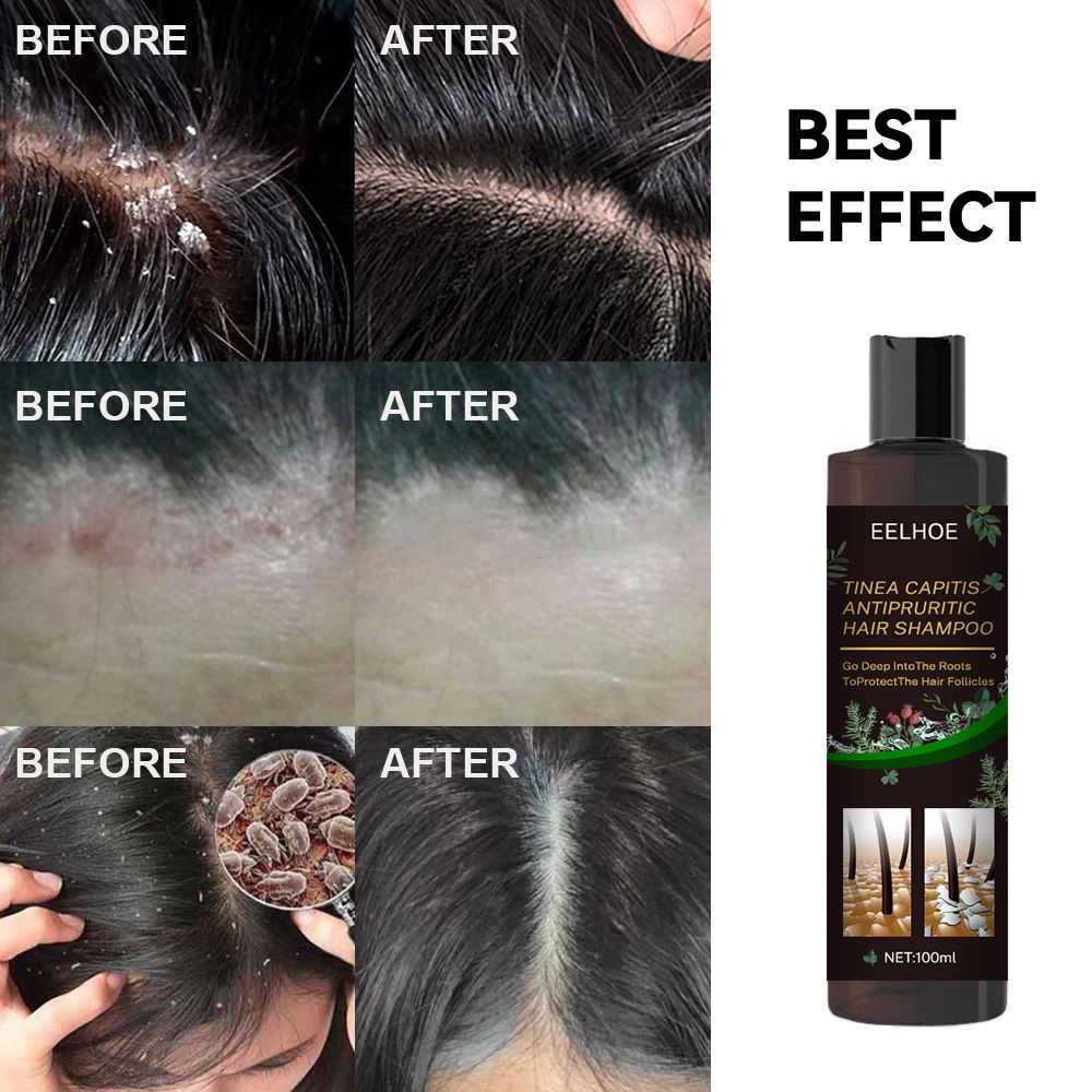 Anti-Dandruff Shampoo,Shampoo For Scalp Prone To Folliculitis, Dermatitis, Dandruff, Itchy And Flaky Scalp,Treats Dandruff And Seborrheic Dermatitis,Anti-Itch Shampoo